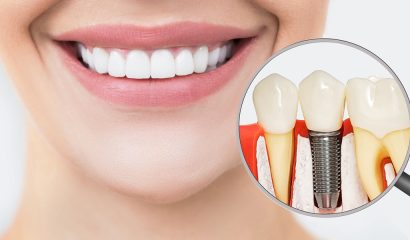 Stop Facial Bone Loss: The Power of Durham Dental Implants